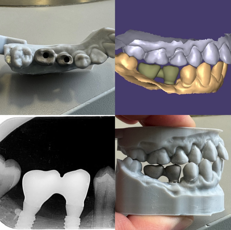 metal-corones